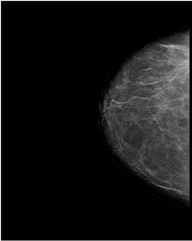 Raw Mammogram